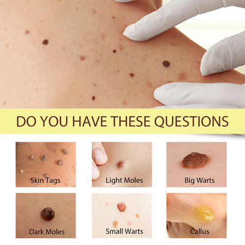 Mole & Wart Remover Cream🤩–Fast & Effective Skin Solution